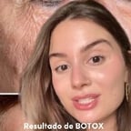 Resultado de botox em casa sem agulhas
