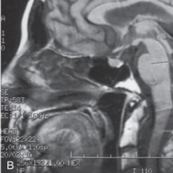 Voz de Niña Juguetona